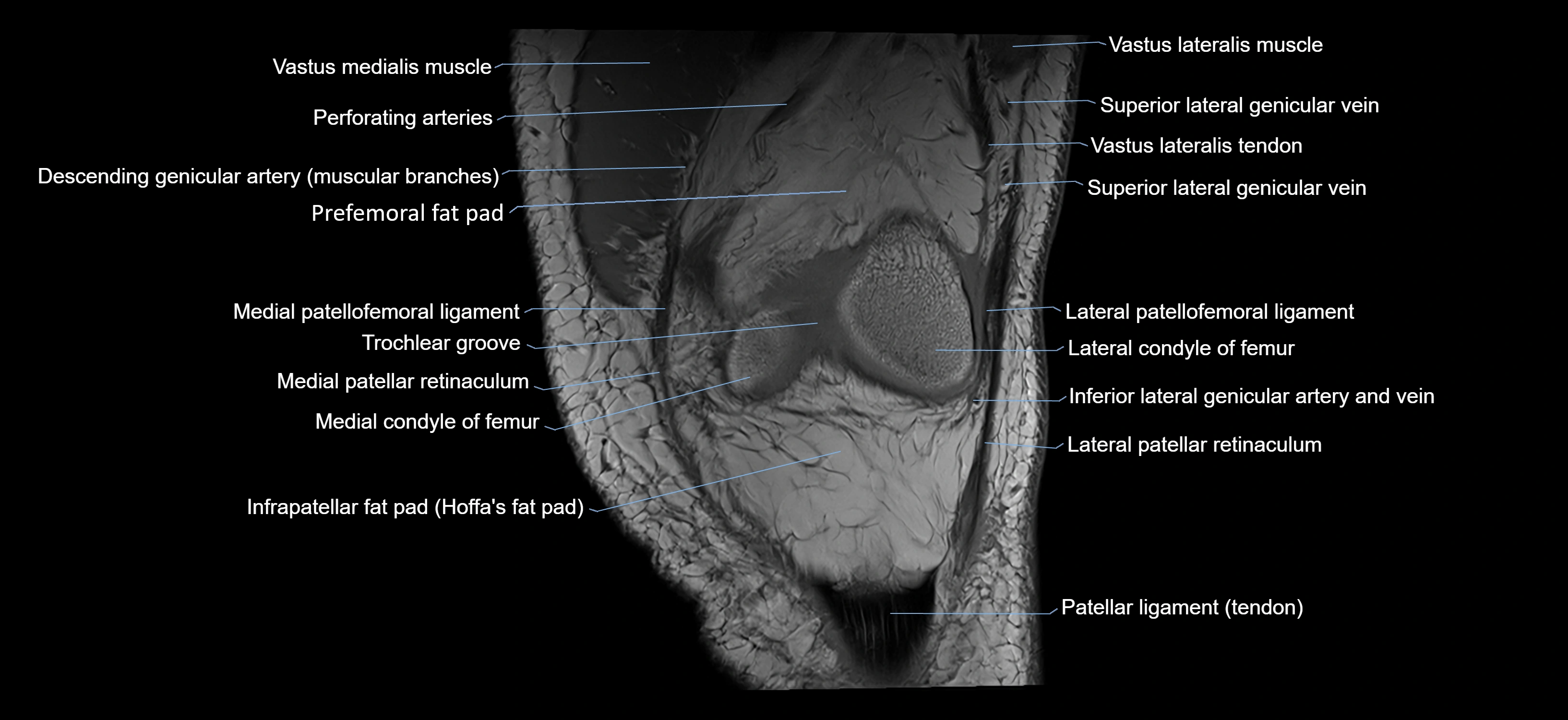MRI knee coronal cross sectional anatomy labelled 3T radiology  image-04001-00010.webp